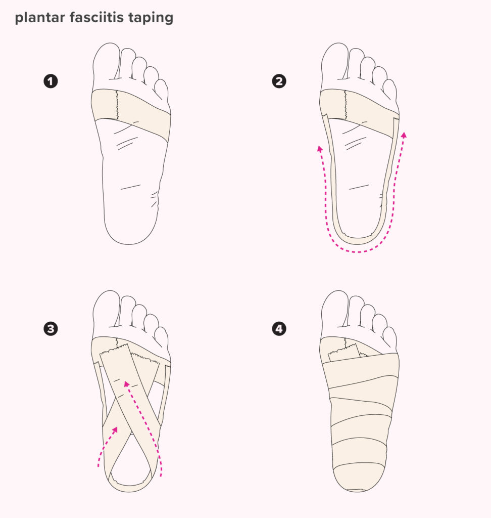 plantar-fasciitis-all-972x1024.jpg